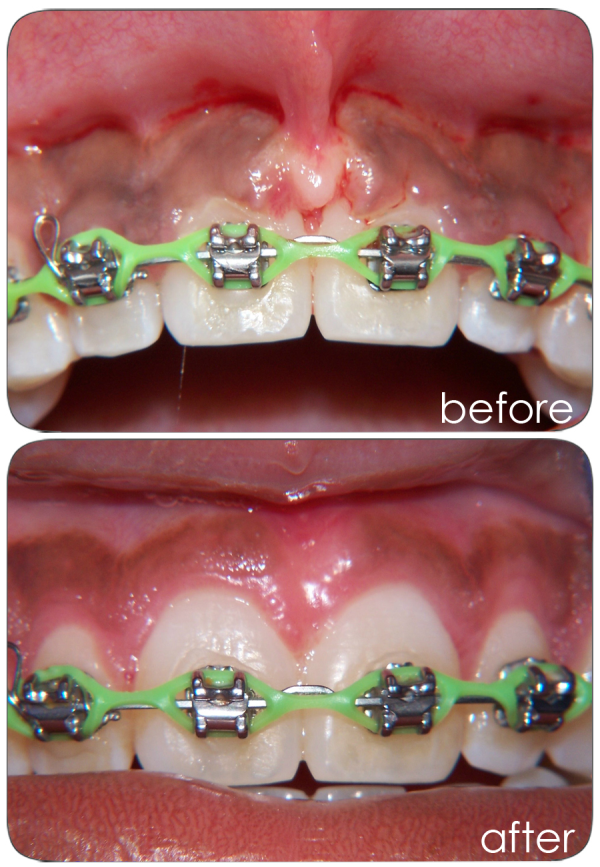 Gingivectomy Lake Charles, LA Raymond J. Steiner, DDS